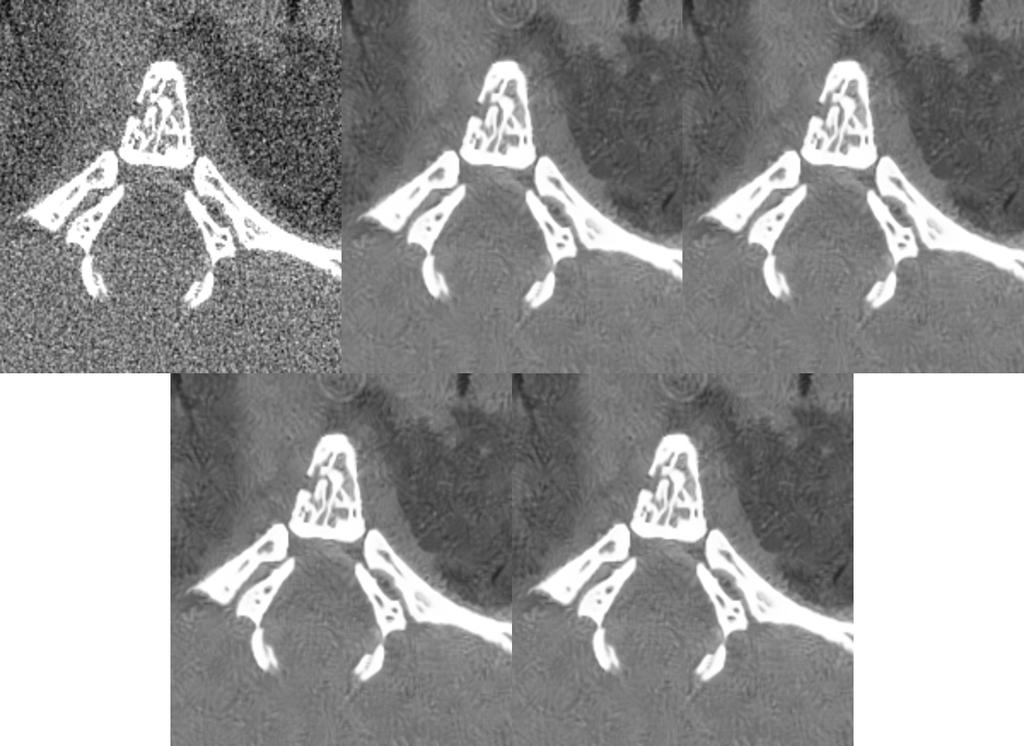 102 (a) Head images and corresponding profiles, from top to bottom left to right, high dose image, low dose image, the results of guided filter, NLM filter, and proposed filter with single NEE and 3