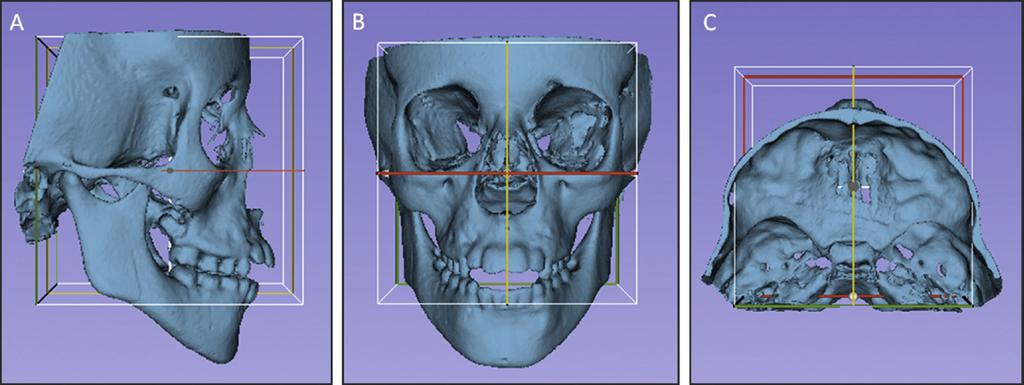 de Oliveira Ruellas et al. Page 16 Fig 4. Figures illustrating the head orientation procedure: A, lateral view; B, frontal view; and C, superior view.