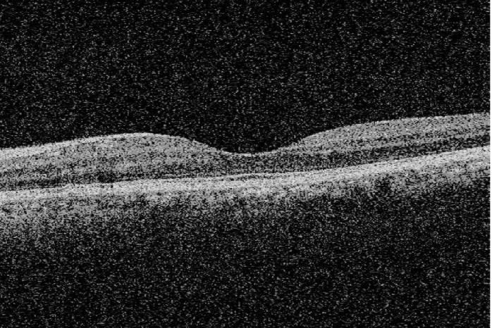 Figure 3.1: (a) A sample macular SD-OCT image from the test dataset showing a healthy adult retina Figure 3.