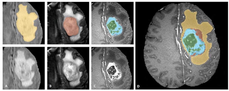 MRI Brain Tumor Segmentation 4 Multimodal scans describe: a) native (T1) and b) postcontrast T1-weighted (T1Gd), c) T2-weighted (T2), and d)