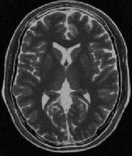 ) SBC Brainweb T2-weighted MR image.