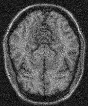 Examples MRI (Simulated noise) Bilateral