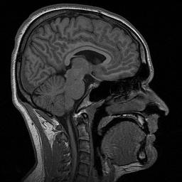 MRI Head