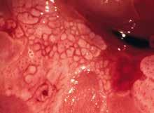 anterior lip, vulnerable, vascular transformation zone on the