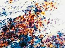 the posterior lip Cytology: Signs of keratinization with