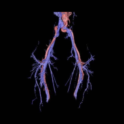 46 Artery-vein