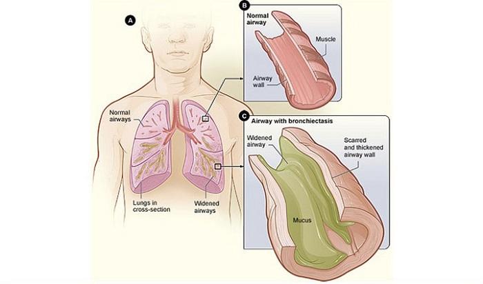 49 Airway and Airway Wall Segmentation with RFC Airways are pathologically involved in various lung diseases.
