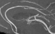 (1) (3) (5) (2) (4) (6) Fig. 6. An illustration of the flow on a 133mm x 214mm x 75mm cropped region of a Gadolinium enhanced MRI.