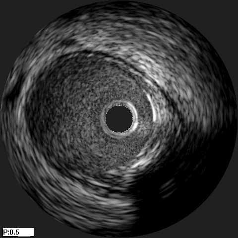 Intravascular ultrasound image segmentation: a three-dimensional fast-marching method based on gray level distributions. T-MI, 25(1):590 601, 2006. [4] T. Chan and W. Zhu.
