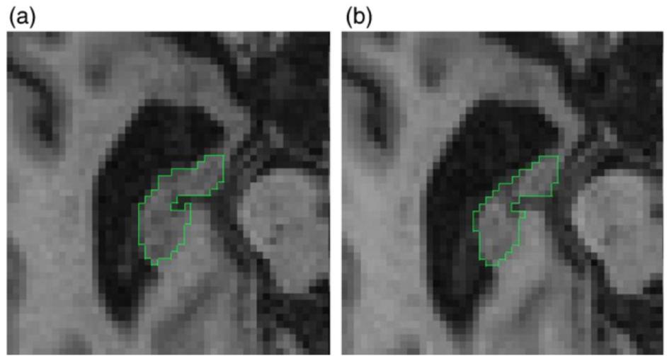 0 Measurement of hippocampal atrophy using 4D graph-cut segmentation: Application to ADNI (Wolz, et