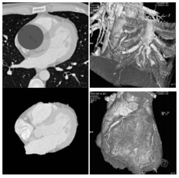 9 AUTOMATIC HEART ISOLATION FOR CT CORONARY VISUALIZATION USING GRAPH-CUTS (Funka-Lea et al, ISBI 006) Top Left: A balloon is expanded within the heart.