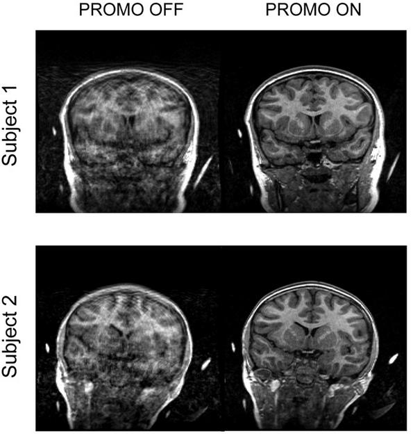 , Rettmann D., Santos J., Kuperman J., Dale A. «PROMO Realtime Prospective Motion Correction in MRI using Image-based Tracking» Magn Reson Med.