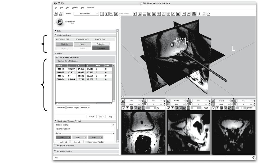 Software Strategy for Robotic Transperineal Prostate Therapy 705 Fig. 2. Screen shot of the graphical user interface (GUI) implemented in the surgical navigation software, 3D Slicer, is shown.