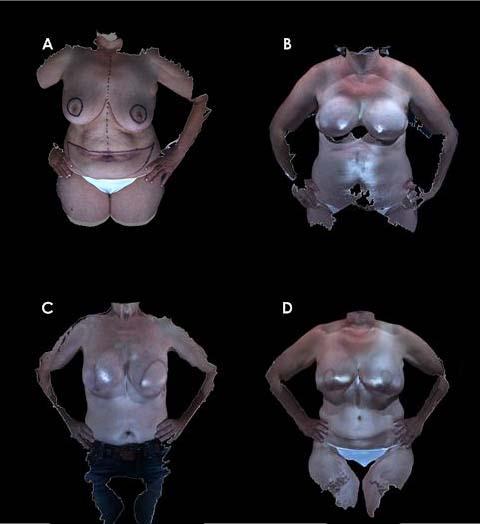 Fig. 3. An example result from our CBR system. (A) This figure depicts the pre-operative image of one test patient (ID # T4). She was 55 years old with a BMI of 30.