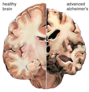 Structural changes in Alzheimer s Alzheimer s disease leads to nerve cell death and tissue loss throughout the brain.