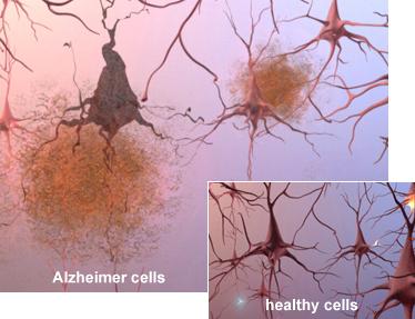 Alzheimer s under the microscope Plaques, clusters of protein beta-amyloid fragments, build up between nerve cells.