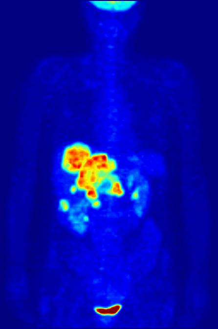 PET Image Areas with high glucose intake will be brighter Higher intake of radioactive molecules Bimodal