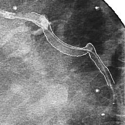 detection of the lumen border in one of the IVUS images, note the out-of-center position of the catheter. Transducer Vessel Lumen IVUS Frames Sheath Fig. 2.