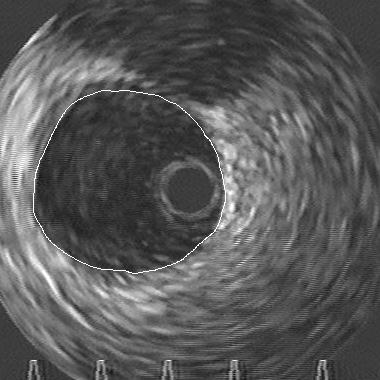 While the absolute orientations of the IVUS cross-sections in the images are arbitrary, their orientations relative to each other are fixed. B.