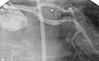 application of the absolute orientation algorithm; (c) independent angiogram in frontal projection for comparison; (d) length of the out-of-center vector for each IVUS image; (e) local correction