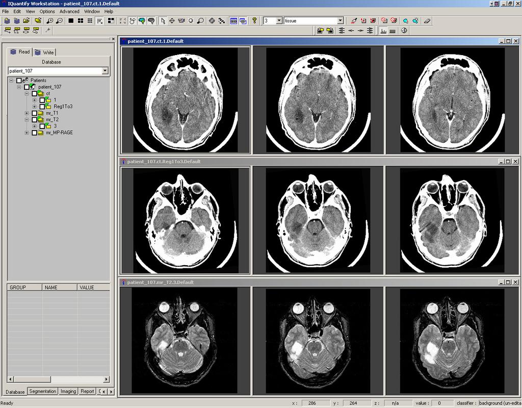 Product Integration: IQuantify* CT to MR-T2 Rigid Registration using Mutual Information. Top row shows selected CT slices before registration.
