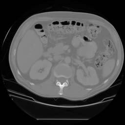 Medical Applications CT image of a patient s abdomen liver