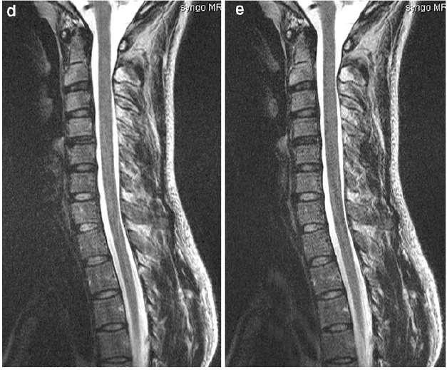 Use #2: Spinal Imaging D: non-pmri E: R=2 Image quality is of similar quality