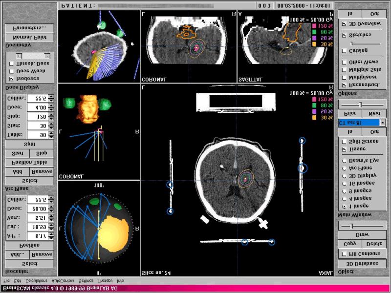 Fig. 2. Stereotactic radiosurgery treatment planning with the BrainLAB system 2. Medical imaging There is a rich variety of available medical imaging techniques (CT, MRI, PET, SPECT, USG, ).
