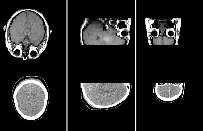 Fig. 6. Source CT and MRI 3D images Figure 7 shows 2D histograms (constructed as described in Chapter 4) of the images before and after the registration. Fig. 7. 2D histograms before (I=0.