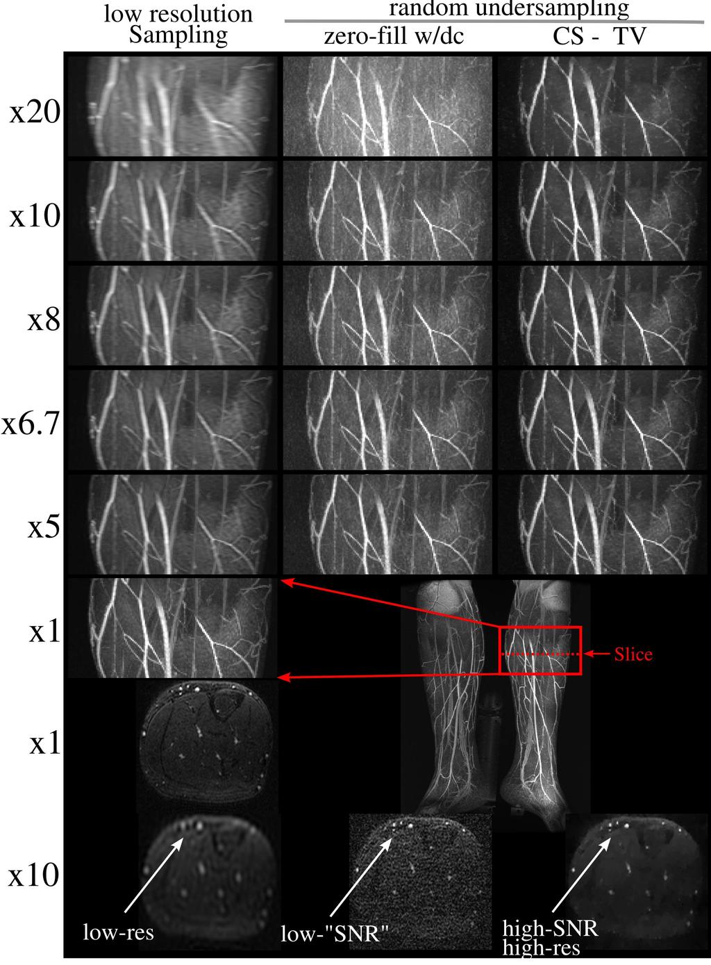 Figure 9: Contrast-enhanced 3D angiography reconstruction results as a function of acceleration. Left Column: Acceleration by LR. Note the diffused boundaries with acceleration.