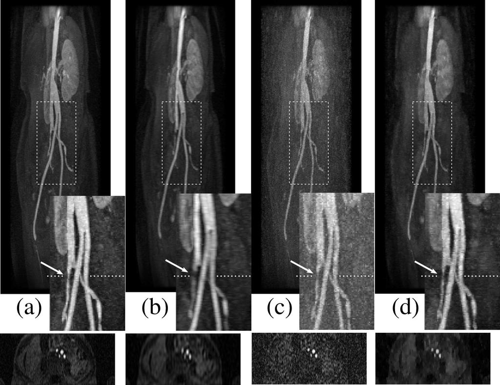 Figure 10: Reconstruction from 5-fold accelerated acquisition of first-pass contrast enhanced abdominal angiography. (a) Reconstruction from a complete data set.