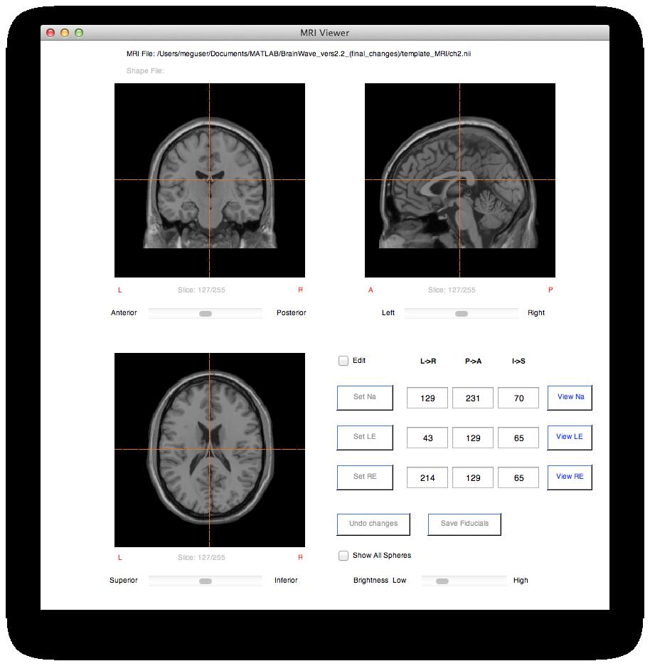 2) MRI Viewer / Head Models This feature allows users to open, convert, edit and perform basic head modeling analyses to a subject s MRI image, without the need for