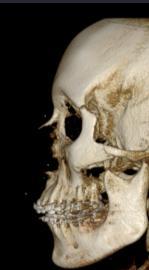Pre-op image Post-op image Superimposition image Compare pre-implant surgery and