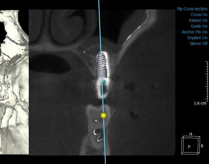 data. Post-op image is re-sliced after fusion Implant in order to generate the