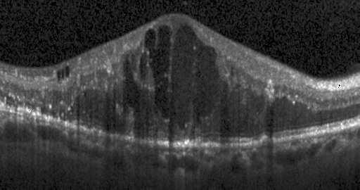 capillaries leads to a swelling of the macular, possibly leading to the destruction of some layers in the retina (Fig. 1 (c)).