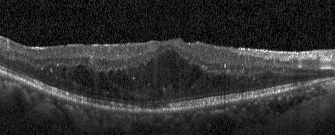 Vitreous Body NFL GCL + IPL INL OPL ONL + IS CC OS RPE Choroid (a) Segmented retina layers.