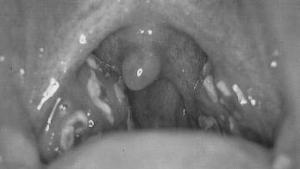 FEATURES OF TONSIL GRANDS Figure 1 shows tonsil grand (TG) called Palatine Tonsil to be two lymph nodes located in the oral cavity on the side of neck with nearly tongue baseness where we can see it