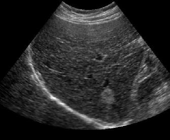 The light boundaries and dark blood vessels appear better segmented in Figure 27: Manual SRG Result on an Ultrasound of Hemangioma in the Liver.