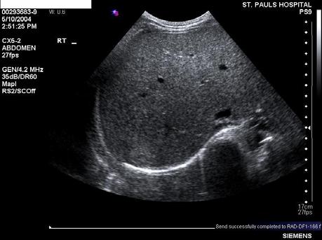 The tumor is often called liver hemangioma and is most often seen in adults over age 40 [5]. These lesions are often viewed without symptoms under routine ultrasound examination.