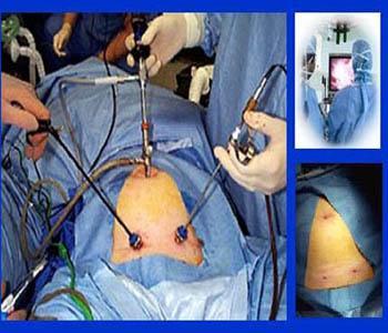 MIS partial Nephrectomy MIS - Surgery through