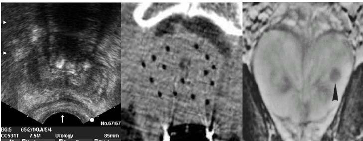MRI-guided prostate biopsy: clinical background Prostate cancer, most common cancer in men Core needle biopsy definitive diagnostic for prostate cancer TRUS has been