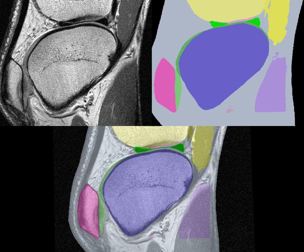 Example : MRI segmented knee Courtesy : Brigham & Women's Hospital Original MRI slice (top, left), Segmentation (top,