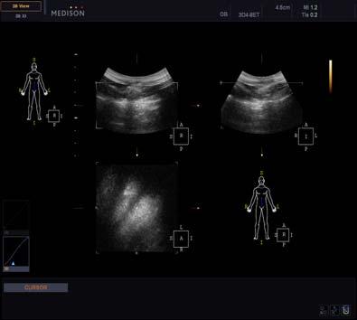 VCE TM (Volume Contrast Enhancement) The quality of volume images is maximized to significantly reduce uncertain areas which appear unclear. Highly detailed images maximize diagnostic confidence.