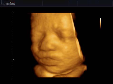29 weeks fetal