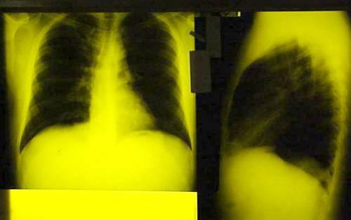 2.2d: A Chest X-ray