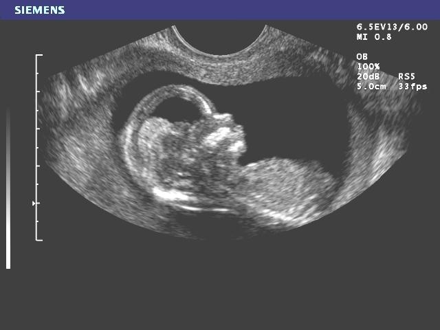 2.6c: Ultrasound Image of