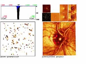 Quantitative 3D imaging with the HRT page 14 A new approach to analyze progression in glaucoma - the probability map analysis - was proposed by Dr. Chauhan and coworkers in Halifax.
