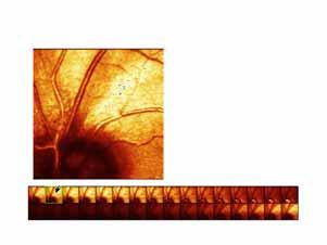Quantitative 3D imaging with the HRT page 16 Figure 33 shows a series of optical section images of an eye with a nerve layer bundle defect.