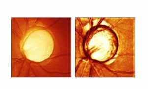 Quantitative 3D imaging with the HRT page 5 3 Analysis of topography images The general application of the Heidelberg Retina Tomograph is the quantitative assessment of the retinal topography and the