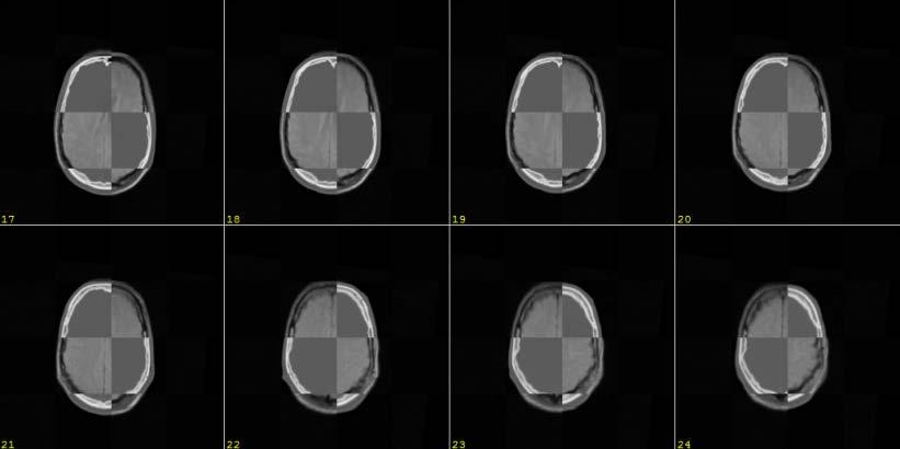 Registration based on Iterative Optimization Example 2 3D Checkerboard of the images after registration (CT/MRI-PD, brain) Registration: 3D,